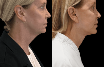 female patient before and after Eve Lift procedure