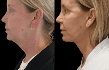 female patient before and after Eve Lift procedure