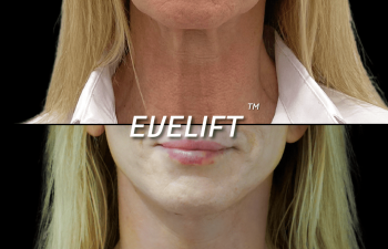 female patient before and after Eve Lift procedure