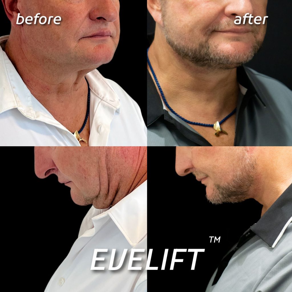 male patient before and after Eve Lift procedure