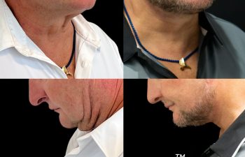 male patient before and after Eve Lift procedure