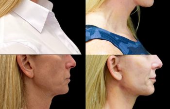 female patient before and after Eve Lift procedure