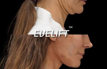 Eden Plastic Surgery Institute female patient's face before and after Eve lift procedure.