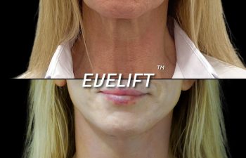 female patient before and after Eve Lift procedure