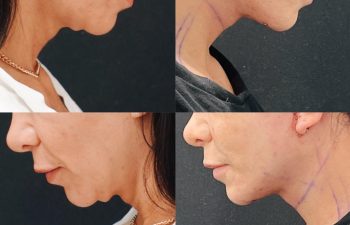 Eden Plastic Surgery Institute female patient's face before and after Eve lift procedure.
