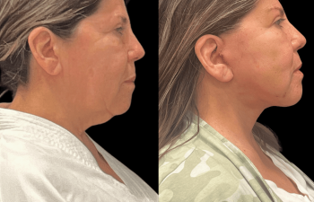 female patient before and after Eve Lift procedure