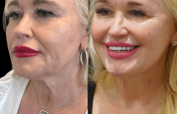 female patient before and after Eve Lift procedure