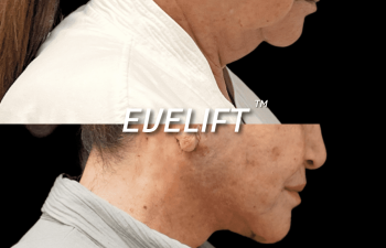 female patient before and after Eve Lift procedure