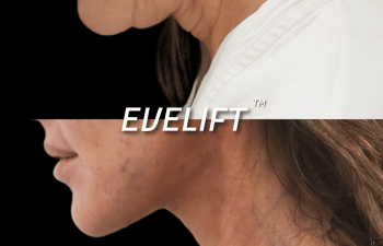 female patient before and after Eve Lift procedure