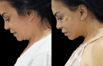 female patient before and after Eve Lift procedure