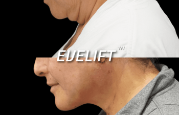 female patient before and after Eve Lift procedure