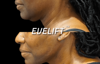 female patient before and after Eve Lift procedure