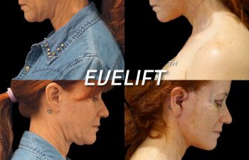 Eden Plastic Surgery Institute female patient's face before and after Eve lift procedure.