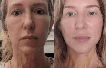female patient before and after Eve Lift procedure