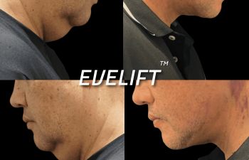 male patient before and after Eve Lift procedure