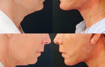 Eden Plastic Surgery Institute female patient's upper face before and after Eve lift procedure.