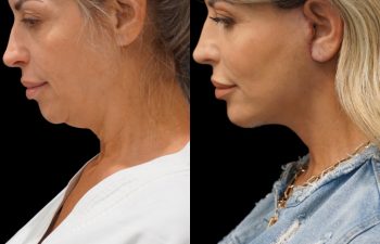 Eden Plastic Surgery Institute female patient's face before and after Eve lift procedure.