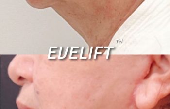 Eden Plastic Surgery Institute female patient's face before and after Eve lift procedure.