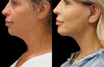 Eden Plastic Surgery Institute female patient's face before and after Eve lift procedure.