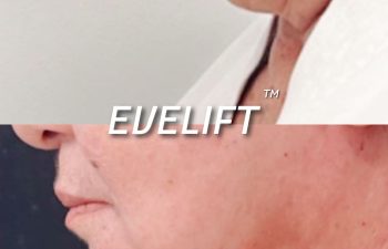 Eden Plastic Surgery Institute female patient's face before and after Eve lift procedure.