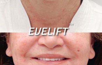 Eden Plastic Surgery Institute female patient's face before and after Eve lift procedure.