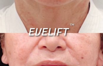 Eden Plastic Surgery Institute female patient's face before and after Eve lift procedure.