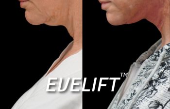 Eden Plastic Surgery Institute female patient's face before and after Eve lift procedure.