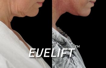 Eden Plastic Surgery Institute female patient's face before and after Eve lift procedure.