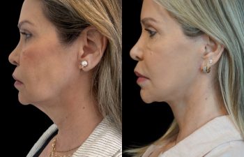 Eden Plastic Surgery Institute female patient's face before and after Eve lift procedure.