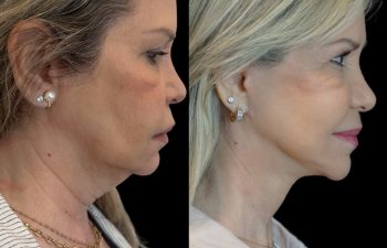 Eden Plastic Surgery Institute female patient's face before and after Eve lift procedure.