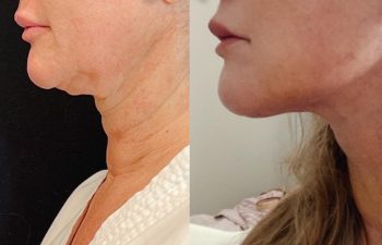 Eden Plastic Surgery Institute female patient's face before and after Eve lift procedure.