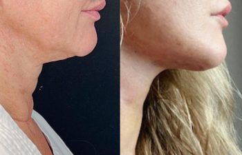 Eden Plastic Surgery Institute female patient's face before and after Eve lift procedure.