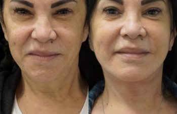 Eden Plastic Surgery Institute female patient's face before and after Eve lift procedure.