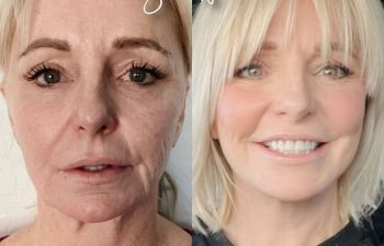 Eden Plastic Surgery Institute female patient's face before and after Eve lift procedure.