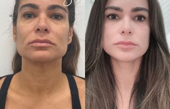 Eden Plastic Surgery Institute female patient's face before and after Eve lift procedure.