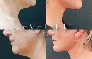 Eden Plastic Surgery Institute female patient's face before and after Eve lift procedure.