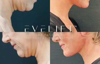 Eden Plastic Surgery Institute female patient's face before and after Eve lift procedure.