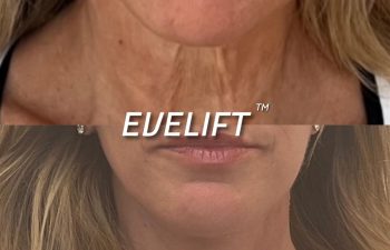 Eden Plastic Surgery Institute female patient's face before and after Eve lift procedure.