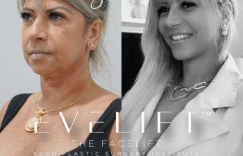 Eden Plastic Surgery Institute female patient's face before and after Eve lift procedure.
