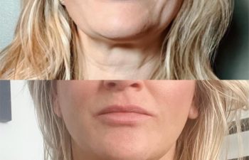 Eden Plastic Surgery Institute female patient's face before and after Eve lift procedure.