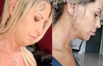 Eden Plastic Surgery Institute female patient's face before and after Eve lift procedure.