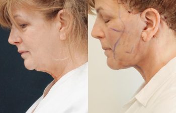 Eden Plastic Surgery Institute female patient's face before and after Eve lift procedure.