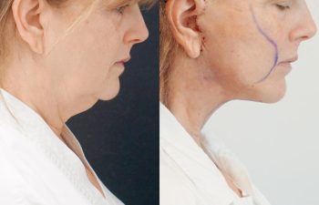 Eden Plastic Surgery Institute female patient's face before and after Eve lift procedure.