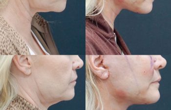 Eden Plastic Surgery Institute female patient's face before and after Eve lift procedure.