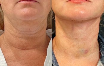Eden Plastic Surgery Institute female patient's face before and after Eve lift procedure.