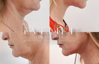 Eden Plastic Surgery Institute female patient's face before and after Eve lift procedure.