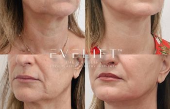 Eden Plastic Surgery Institute female patient's face before and after Eve lift procedure.