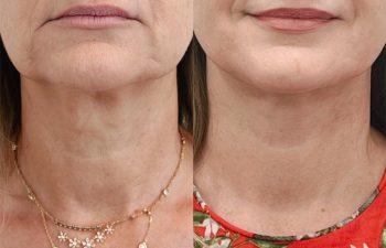 Eden Plastic Surgery Institute female patient's face before and after Eve lift procedure.