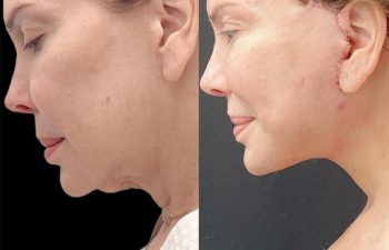 Eden Plastic Surgery Institute female patient's face before and after Eve lift procedure.