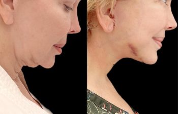 Eden Plastic Surgery Institute female patient's face before and after Eve lift procedure.